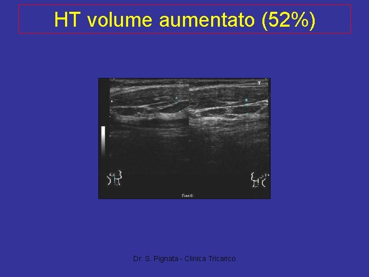 HT volume aumentato (52%) Dr. S. Pignata - Clinica Tricarico 