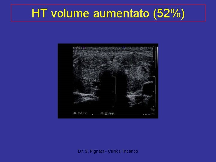 HT volume aumentato (52%) Dr. S. Pignata - Clinica Tricarico 