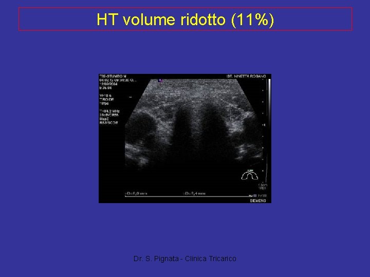 HT volume ridotto (11%) Dr. S. Pignata - Clinica Tricarico HT volume ridotto (11%) Dr. S. Pignata - Clinica Tricarico