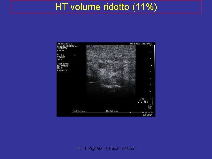 HT volume ridotto (11%) Dr. S. Pignata - Clinica Tricarico 