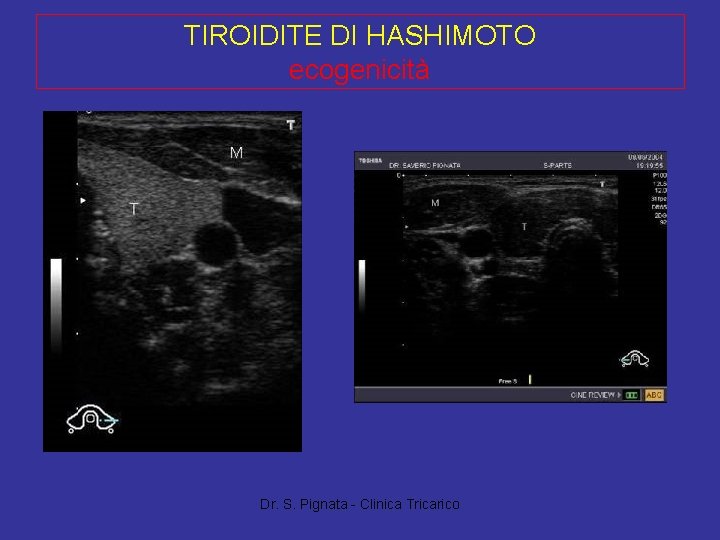 TIROIDITE DI HASHIMOTO ecogenicità Dr. S. Pignata - Clinica Tricarico 