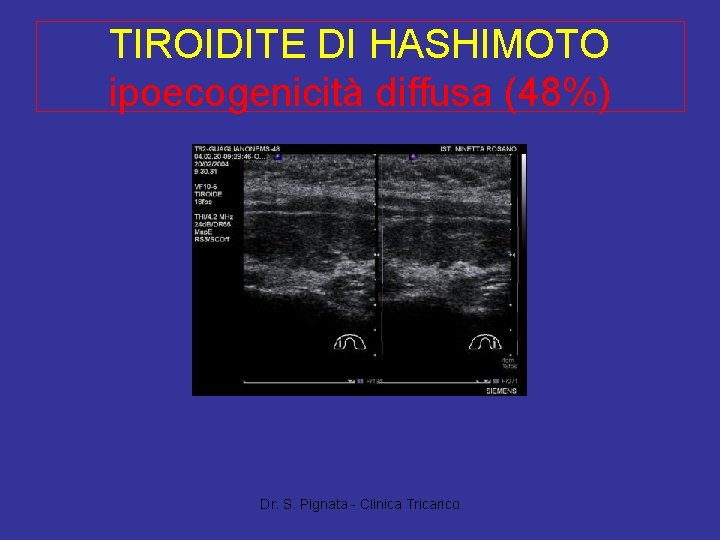 TIROIDITE DI HASHIMOTO ipoecogenicità diffusa (48%) Dr. S. Pignata - Clinica Tricarico 