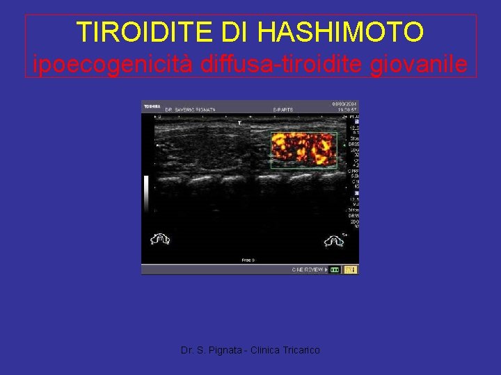 TIROIDITE DI HASHIMOTO ipoecogenicità diffusa-tiroidite giovanile Dr. S. Pignata - Clinica Tricarico 