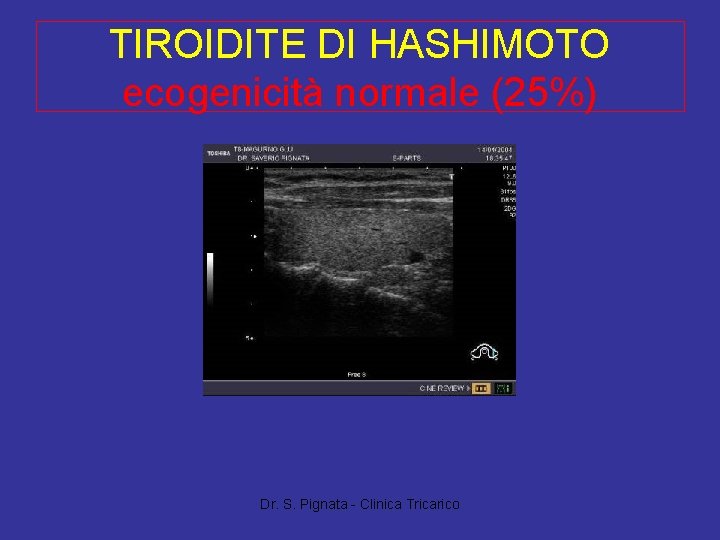 TIROIDITE DI HASHIMOTO ecogenicità normale (25%) Dr. S. Pignata - Clinica Tricarico 
