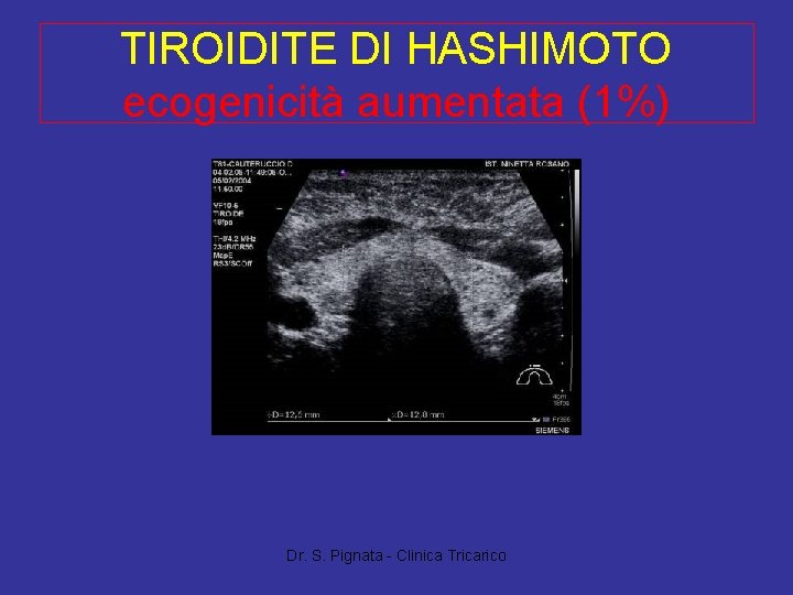 TIROIDITE DI HASHIMOTO ecogenicità aumentata (1%) Dr. S. Pignata - Clinica Tricarico TIROIDITE DI HASHIMOTO ecogenicità aumentata (1%) Dr. S. Pignata - Clinica Tricarico