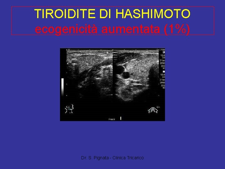 TIROIDITE DI HASHIMOTO ecogenicità aumentata (1%) Dr. S. Pignata - Clinica Tricarico TIROIDITE DI HASHIMOTO ecogenicità aumentata (1%) Dr. S. Pignata - Clinica Tricarico