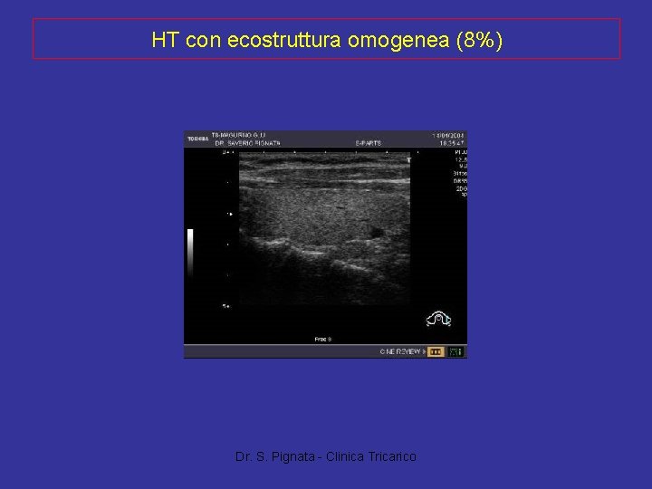 HT con ecostruttura omogenea (8%) Dr. S. Pignata - Clinica Tricarico 