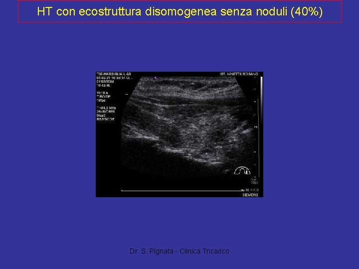 HT con ecostruttura disomogenea senza noduli (40%) Dr. S. Pignata - Clinica Tricarico 