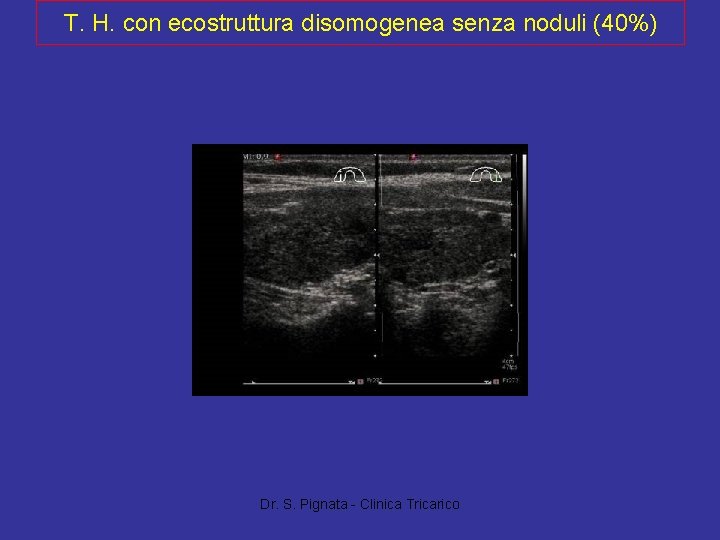 T. H. con ecostruttura disomogenea senza noduli (40%) Dr. S. Pignata - Clinica Tricarico