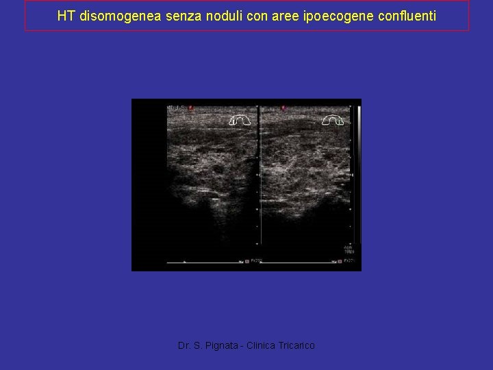 HT disomogenea senza noduli con aree ipoecogene confluenti Dr. S. Pignata - Clinica Tricarico