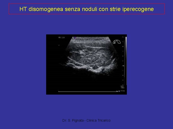 HT disomogenea senza noduli con strie iperecogene Dr. S. Pignata - Clinica Tricarico 