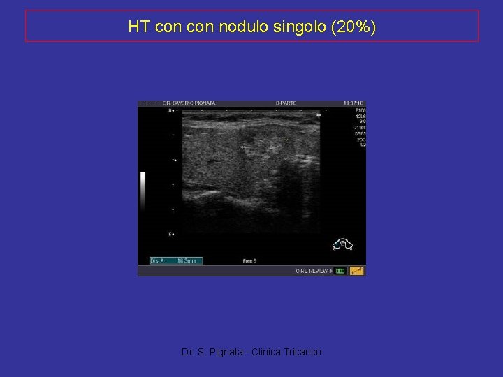 HT con nodulo singolo (20%) Dr. S. Pignata - Clinica Tricarico 