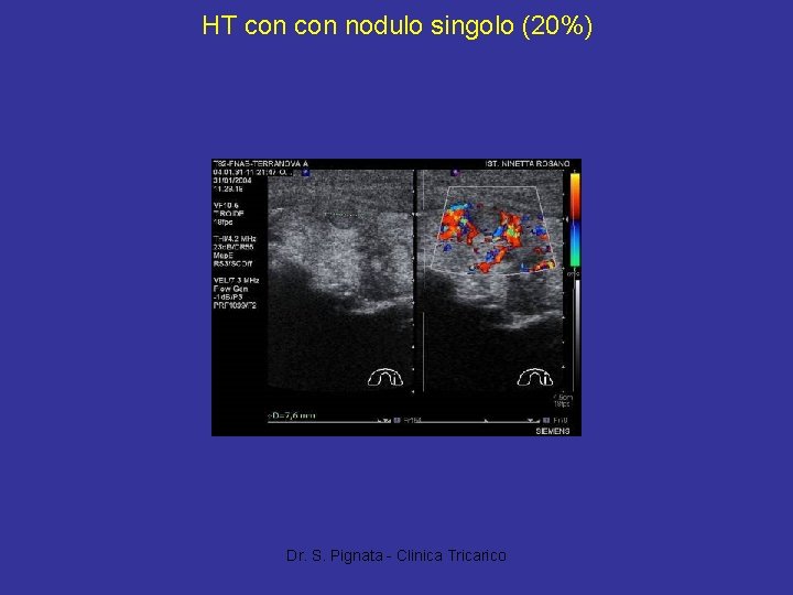 HT con nodulo singolo (20%) Dr. S. Pignata - Clinica Tricarico 