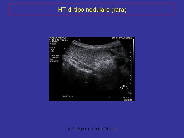 HT di tipo nodulare (rara) Dr. S. Pignata - Clinica Tricarico 