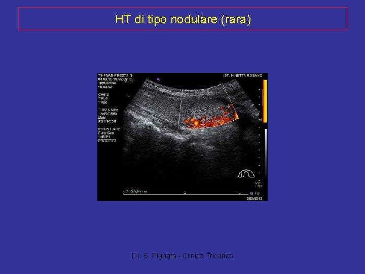 HT di tipo nodulare (rara) Dr. S. Pignata - Clinica Tricarico 