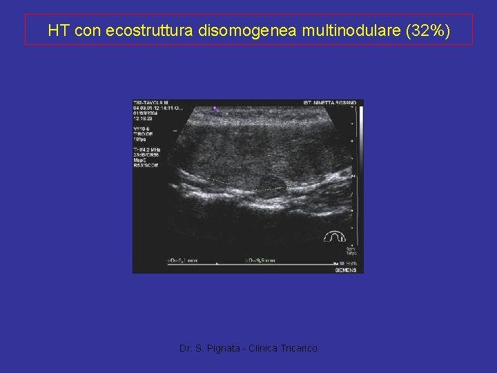 HT con ecostruttura disomogenea multinodulare (32%) Dr. S. Pignata - Clinica Tricarico 