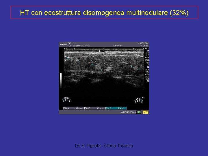 HT con ecostruttura disomogenea multinodulare (32%) Dr. S. Pignata - Clinica Tricarico 