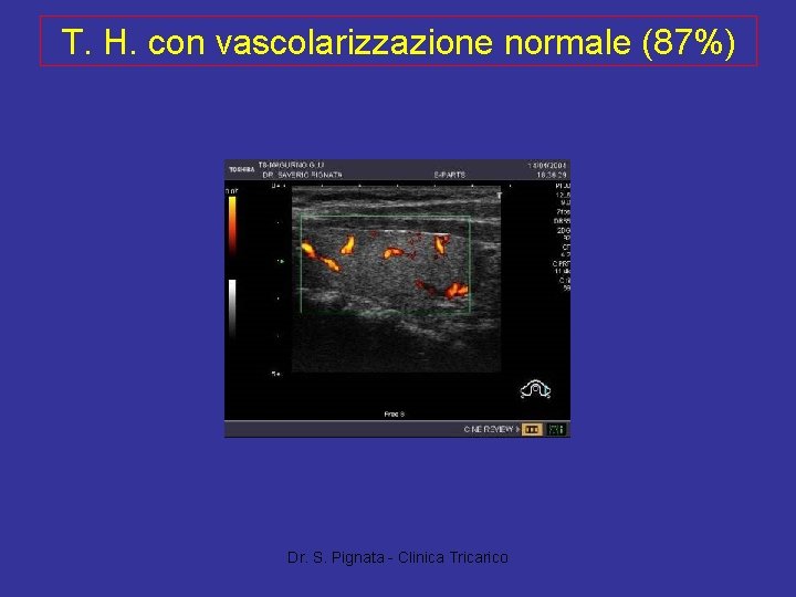 T. H. con vascolarizzazione normale (87%) Dr. S. Pignata - Clinica Tricarico 