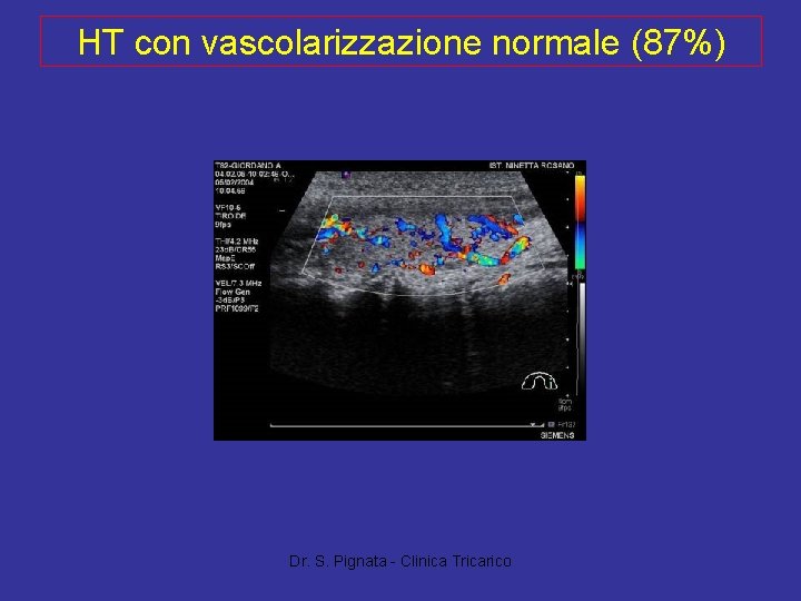 HT con vascolarizzazione normale (87%) Dr. S. Pignata - Clinica Tricarico 