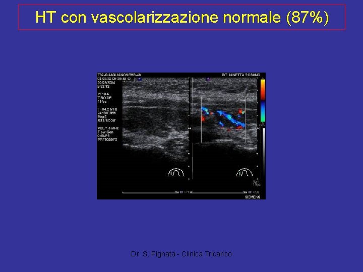 HT con vascolarizzazione normale (87%) Dr. S. Pignata - Clinica Tricarico 