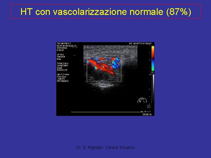 HT con vascolarizzazione normale (87%) Dr. S. Pignata - Clinica Tricarico 