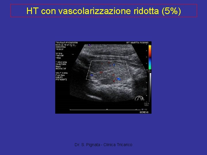 HT con vascolarizzazione ridotta (5%) Dr. S. Pignata - Clinica Tricarico 