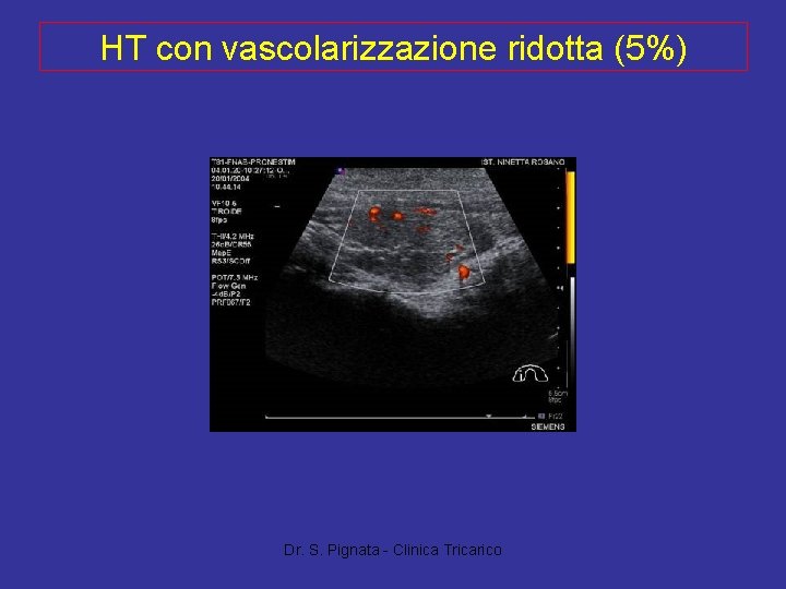 HT con vascolarizzazione ridotta (5%) Dr. S. Pignata - Clinica Tricarico 