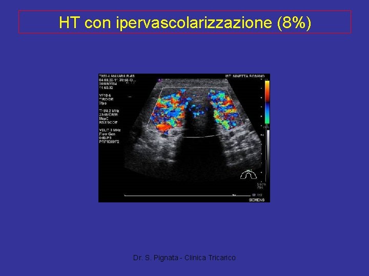 HT con ipervascolarizzazione (8%) Dr. S. Pignata - Clinica Tricarico 