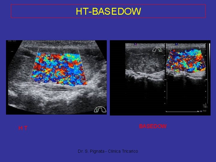 HT-BASEDOW HT Dr. S. Pignata - Clinica Tricarico 