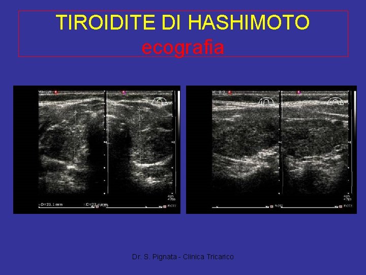 TIROIDITE DI HASHIMOTO ecografia Dr. S. Pignata - Clinica Tricarico 