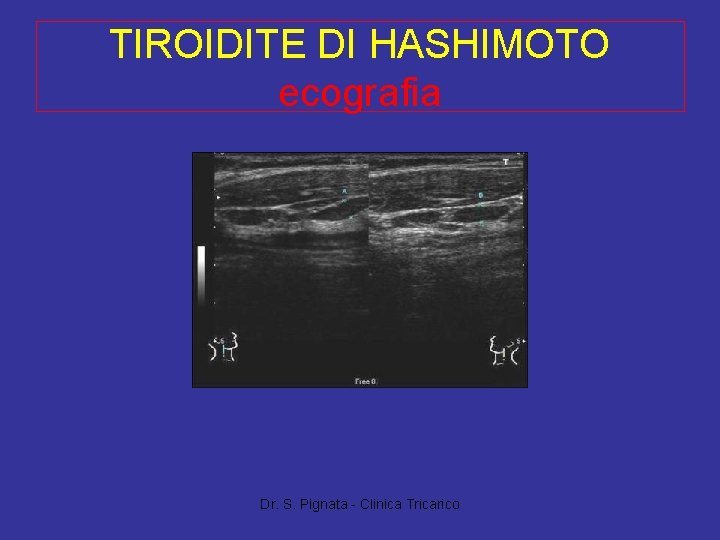 TIROIDITE DI HASHIMOTO ecografia Dr. S. Pignata - Clinica Tricarico 