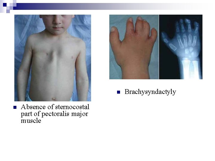 n n Absence of sternocostal part of pectoralis major muscle Brachysyndactyly 