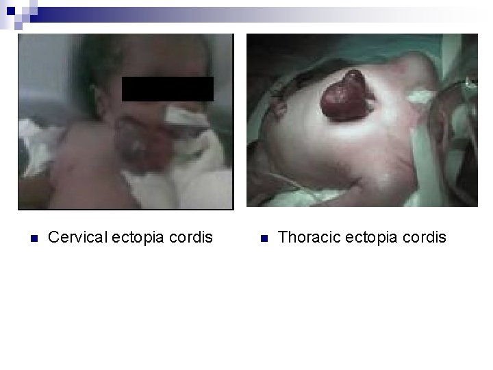 n Cervical ectopia cordis n Thoracic ectopia cordis 