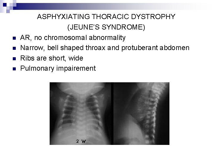 n n ASPHYXIATING THORACIC DYSTROPHY (JEUNE’S SYNDROME) AR, no chromosomal abnormality Narrow, bell shaped