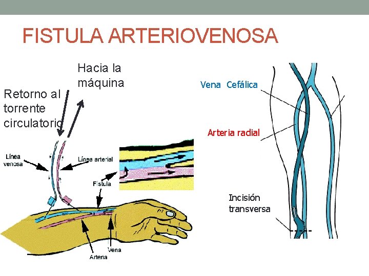 FISTULA ARTERIOVENOSA Retorno al torrente circulatorio Hacia la máquina Vena Cefálica Arteria radial Incisión