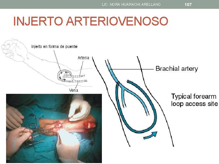 LIC. NORA HUARACHI ARELLANO INJERTO ARTERIOVENOSO 107 