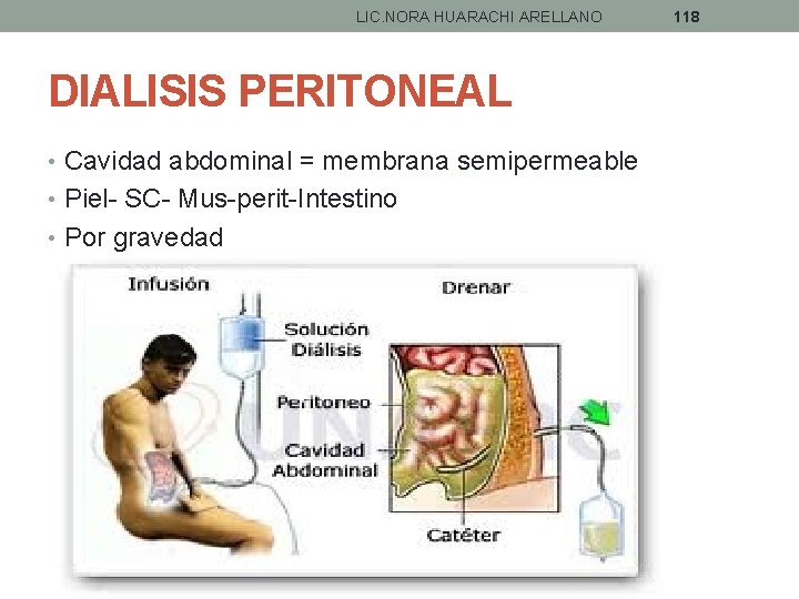 LIC. NORA HUARACHI ARELLANO DIALISIS PERITONEAL • Cavidad abdominal = membrana semipermeable • Piel-