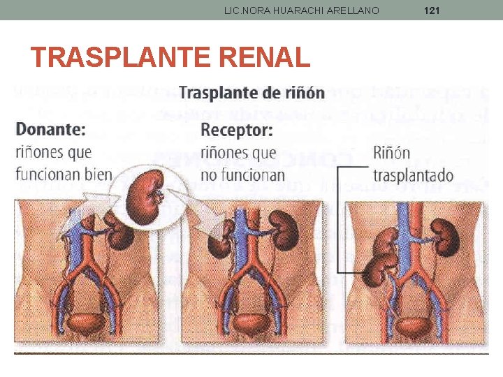 LIC. NORA HUARACHI ARELLANO TRASPLANTE RENAL 121 