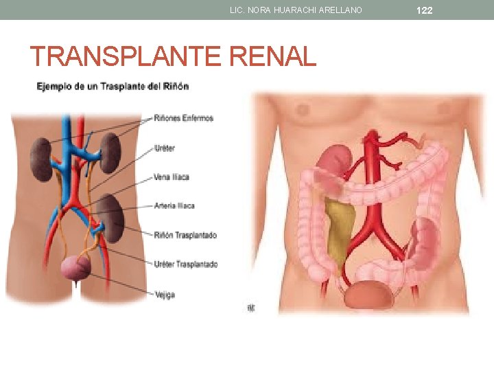 LIC. NORA HUARACHI ARELLANO TRANSPLANTE RENAL 122 