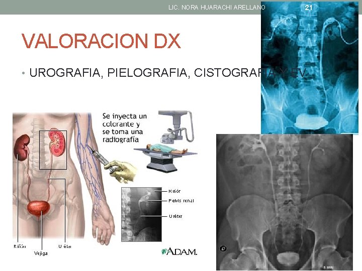 LIC. NORA HUARACHI ARELLANO 21 VALORACION DX • UROGRAFIA, PIELOGRAFIA, CISTOGRAFIA Y EV 