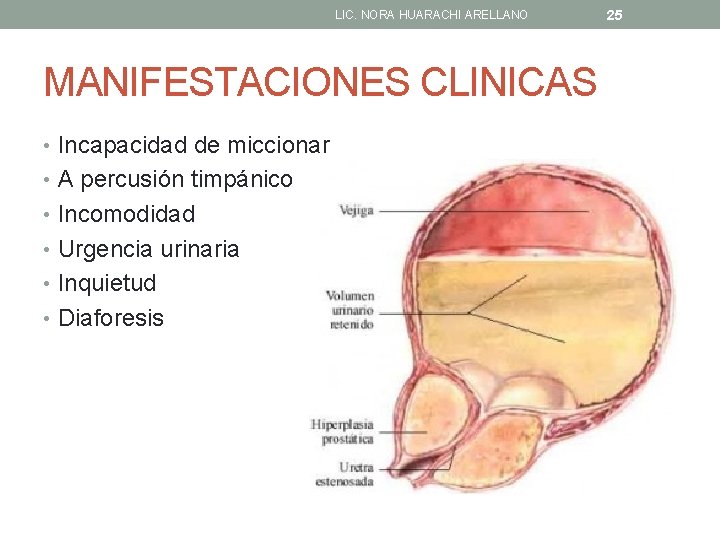 LIC. NORA HUARACHI ARELLANO MANIFESTACIONES CLINICAS • Incapacidad de miccionar • A percusión timpánico