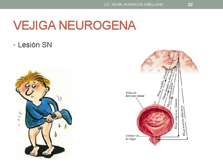 LIC. NORA HUARACHI ARELLANO VEJIGA NEUROGENA • Lesión SN 32 