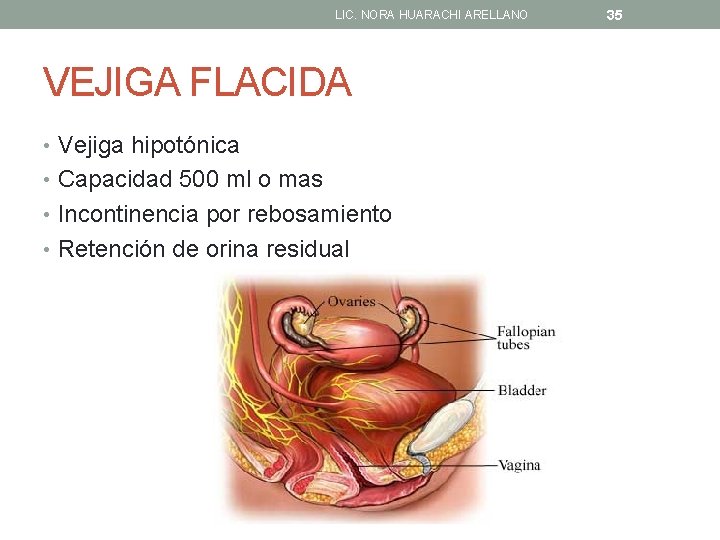 LIC. NORA HUARACHI ARELLANO VEJIGA FLACIDA • Vejiga hipotónica • Capacidad 500 ml o