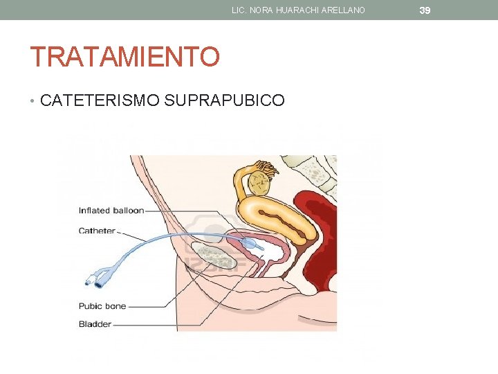 LIC. NORA HUARACHI ARELLANO TRATAMIENTO • CATETERISMO SUPRAPUBICO 39 