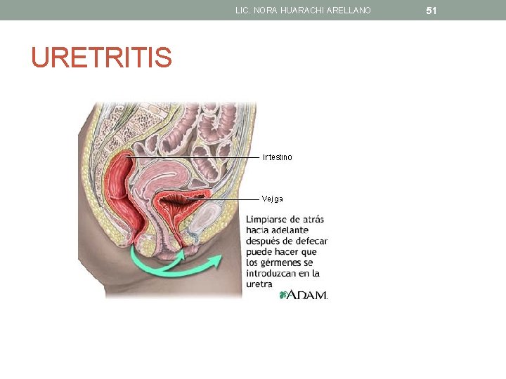 LIC. NORA HUARACHI ARELLANO URETRITIS 51 