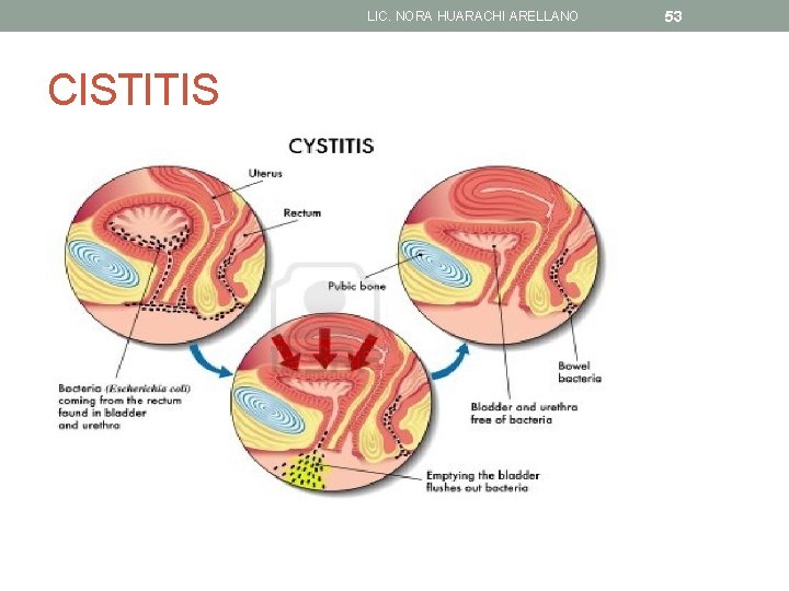 LIC. NORA HUARACHI ARELLANO CISTITIS 53 