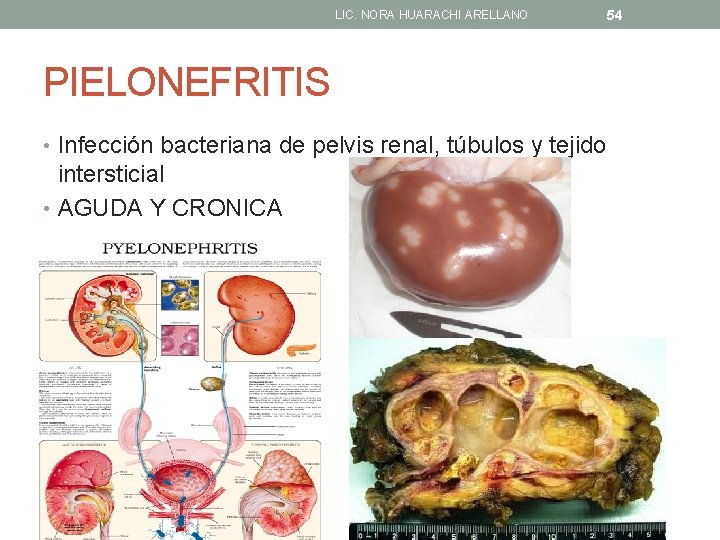 LIC. NORA HUARACHI ARELLANO PIELONEFRITIS • Infección bacteriana de pelvis renal, túbulos y tejido