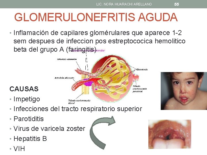 LIC. NORA HUARACHI ARELLANO 55 GLOMERULONEFRITIS AGUDA • Inflamación de capilares glomérulares que aparece