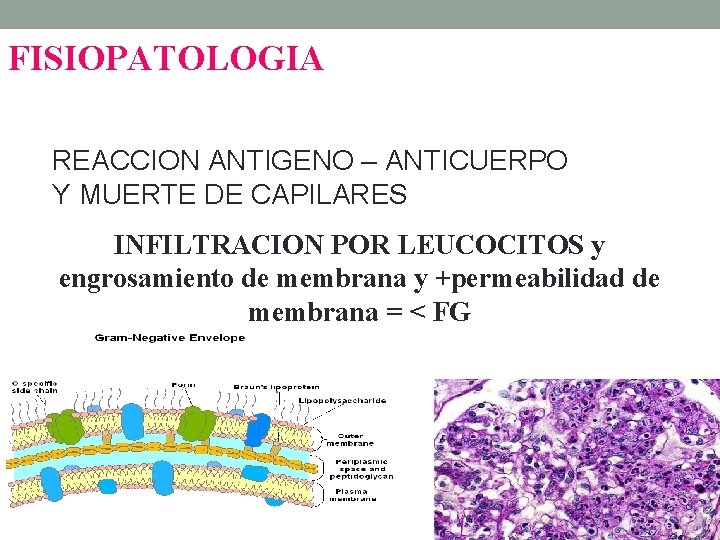 FISIOPATOLOGIA REACCION ANTIGENO – ANTICUERPO Y MUERTE DE CAPILARES INFILTRACION POR LEUCOCITOS y engrosamiento