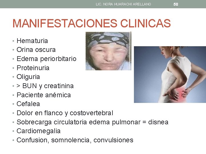 LIC. NORA HUARACHI ARELLANO MANIFESTACIONES CLINICAS • Hematuria • Orina oscura • Edema periorbitario